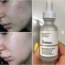 The Ordinary Niacinamide 10% + Zinc 1 % - 30 ml |Oil Control, Pore Minimizing & Blemish Solution Serum